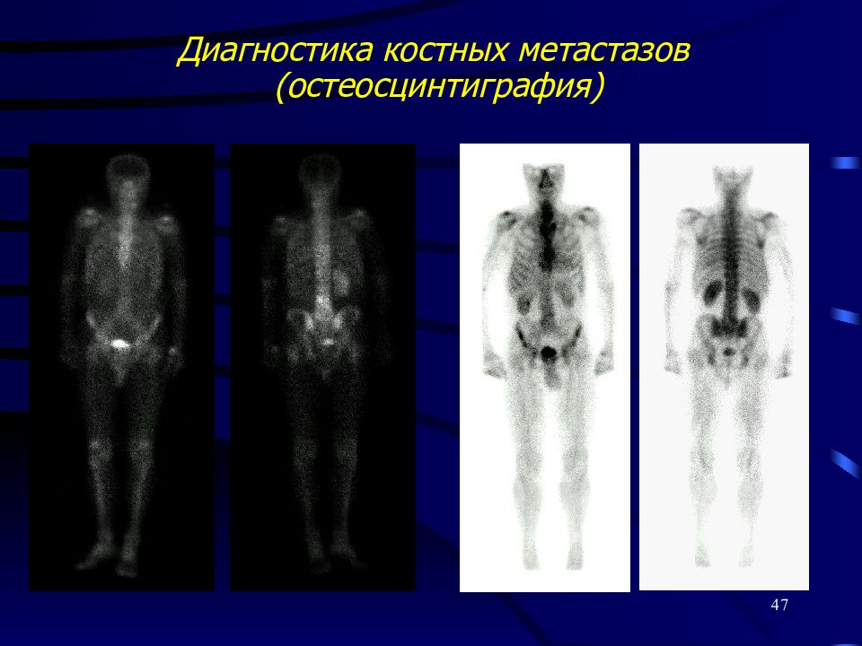 Исследование костей. Сцинтиграфия скелета метастазы. Остеосцинтиграфия артроз. Сцинтиграфия костей метастазы. Сцинтиграфия метастазы в кости.