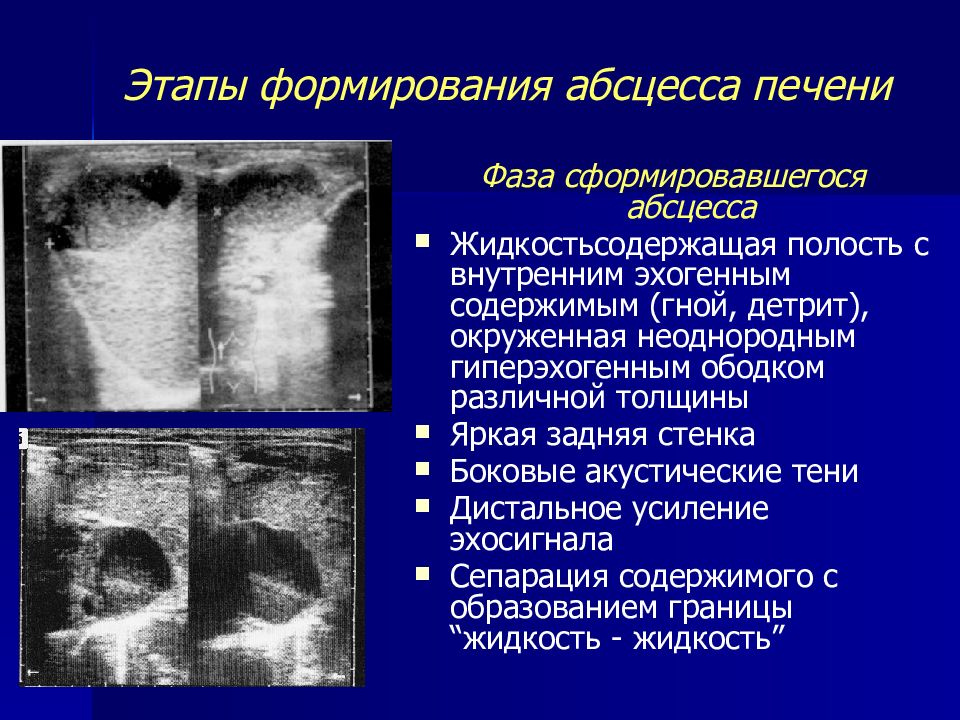 Стадии формирования абсцесса. Очаговые поражения печени. Очаговые поражения печени презентация.