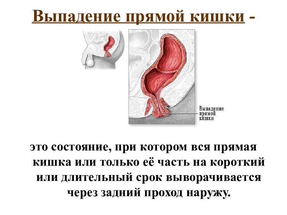 Выпадение прямой кишки презентация