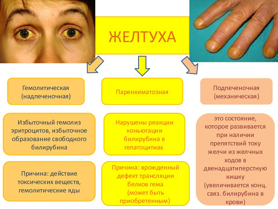 Причины желтых. Гемолитическая желтуха симптомы. Желтуха причины возникновения. Проявления гемолитической желтухи. Надпеченочная (гемолитическая) желтуха.