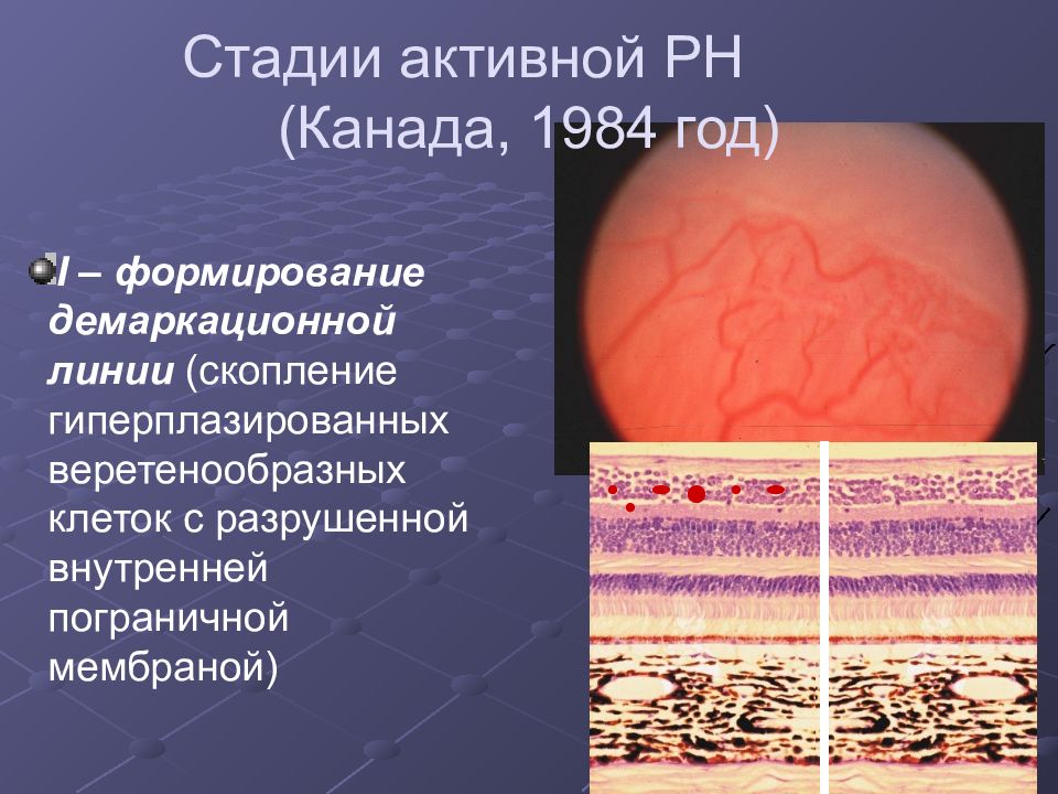 Ретинопатия недоношенных презентация