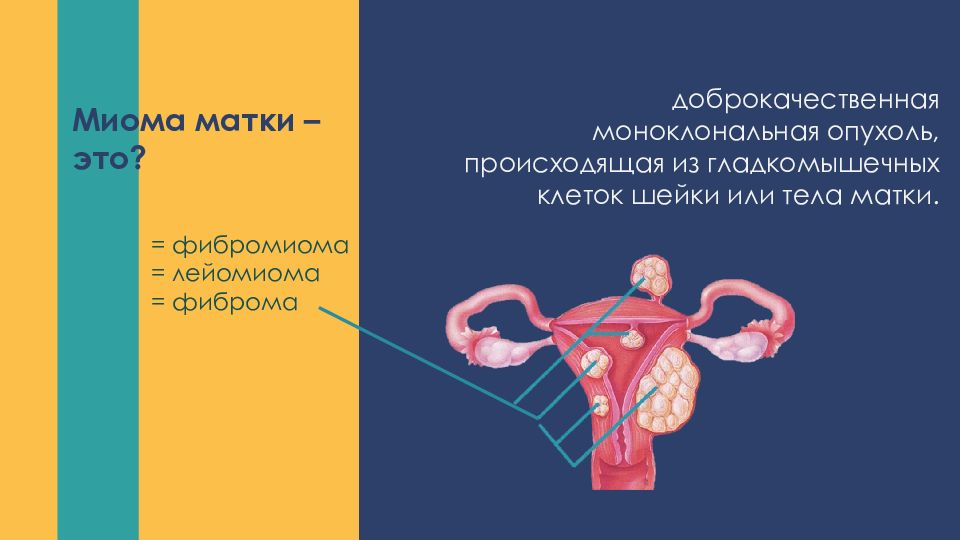 Презентация миома матки и беременность