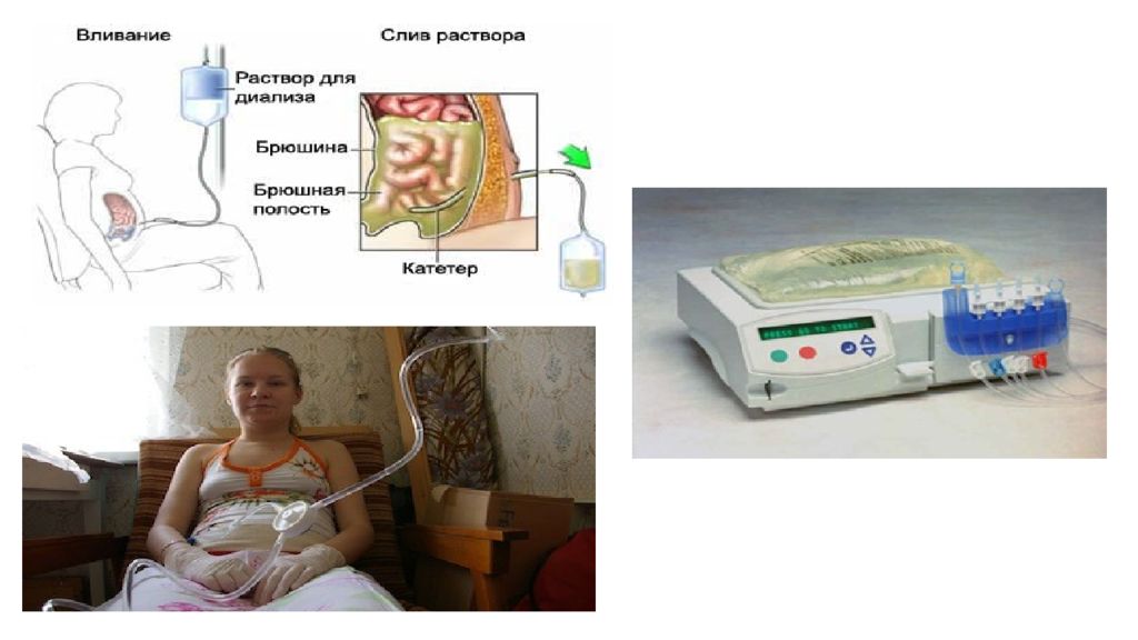 Перитонеальный диализ презентация