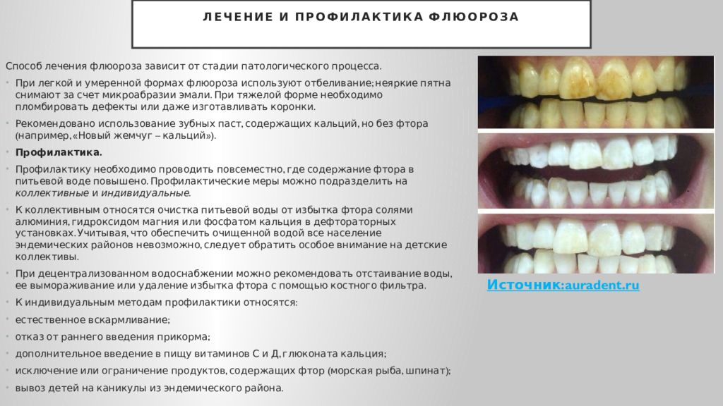 Профилактика фтора среди населения. Некариозные поражения зубов тетрациклиновые зубы. Эндемический флюороз классификация. Флюороз реминерализирующая терапия. Некариозные поражения зубов флюороз.