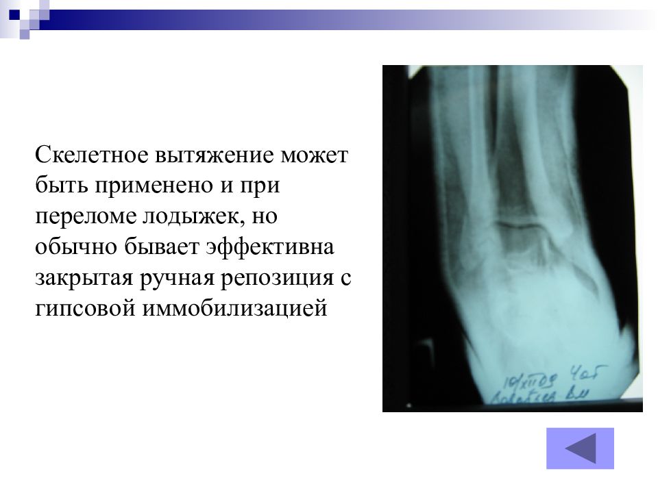 Переломы лодыжек презентация