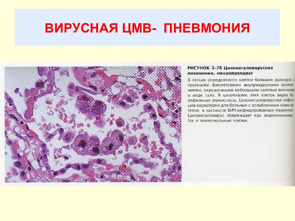 Цитомегаловирус клиническая картина