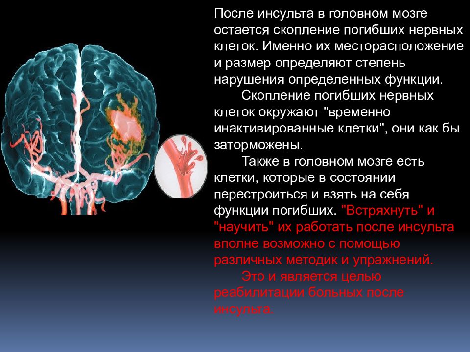 Картинки про инсульт для презентации