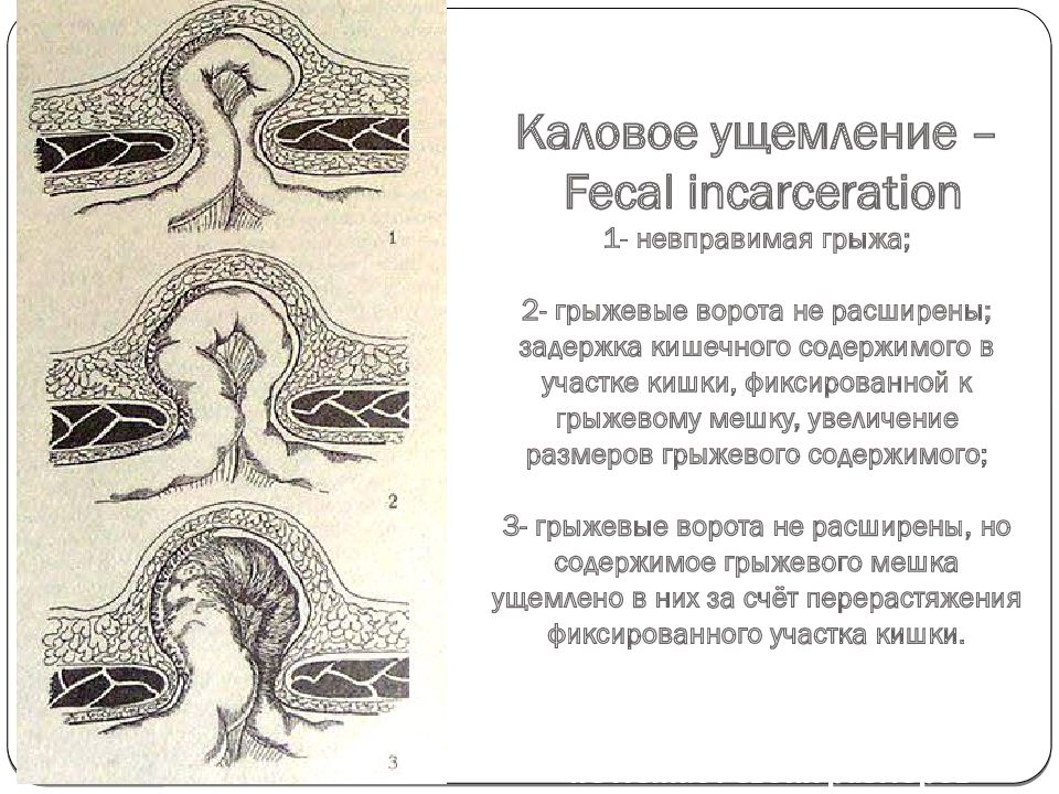 Невправимая грыжа. Каловое ущемление грыжи. Ущемление невправимой грыжи.