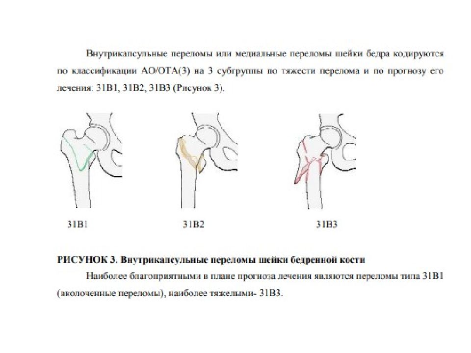 Мкб перелом бедренной. Лизис шейки бедренной кости. Перелом шейки бедренной кости шпаргалка. Остеопороз шейки бедренной кости. Классификация переломов головки бедра Пипкин.