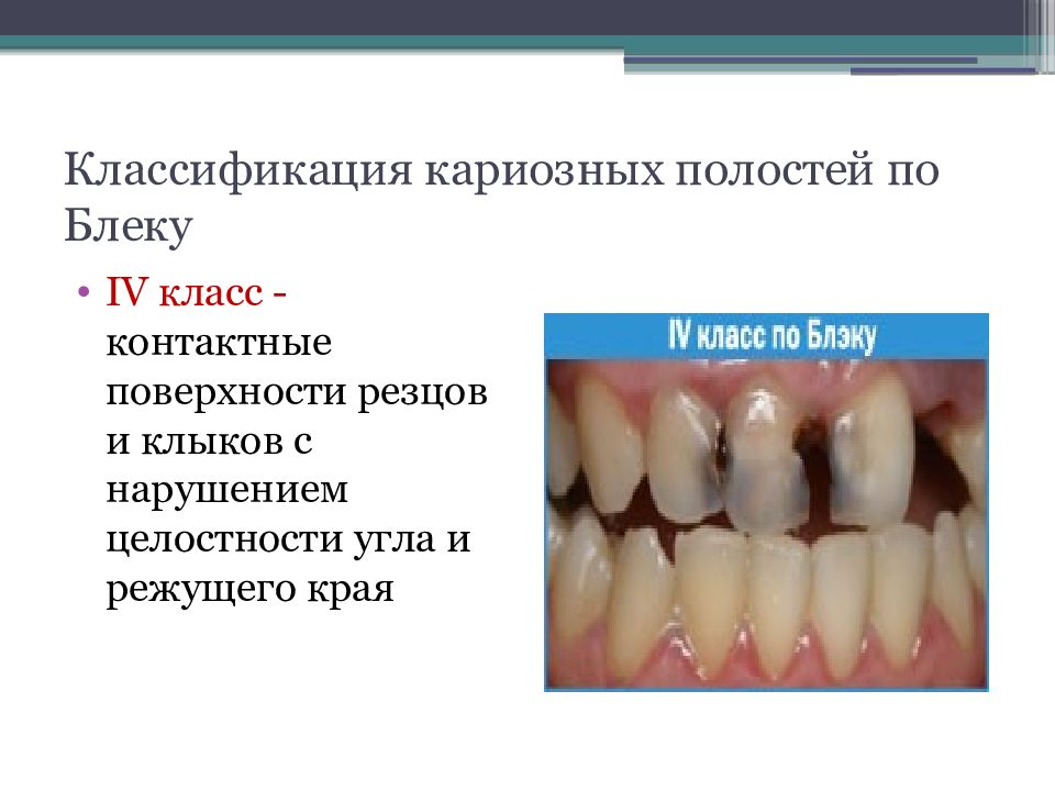 Кариозные полости 4 класса. Классификация полостей по Блейку. Контактные поверхности резцов класс по Блеку. Классификация кариозных полостей.