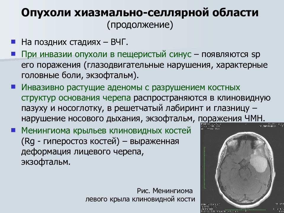 Рак головного мозга презентация