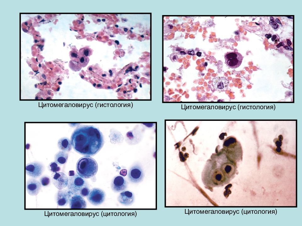 Цитомегаловирус микробиология презентация