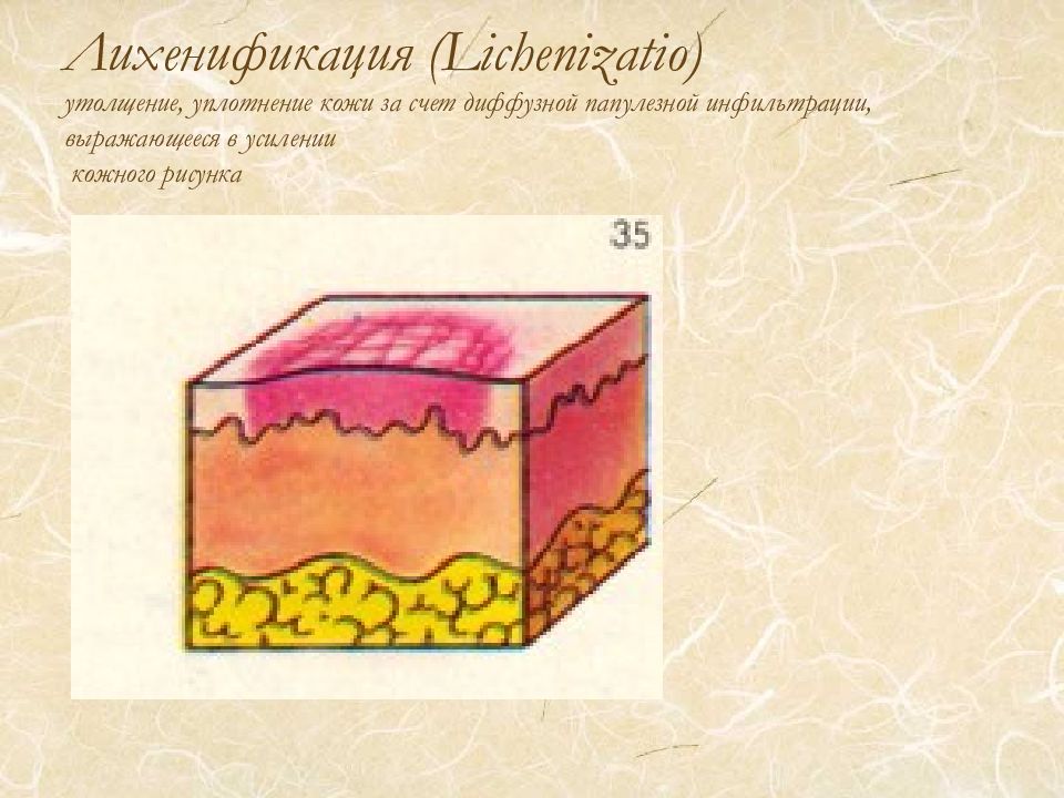 Элементы кожи. Вторичные морфологические элементы лихенификация. Вторичные элементы сыпи лихенификация. Лихенификация морфологические элементы кожной сыпи. Лихенификация морфологический элемент.