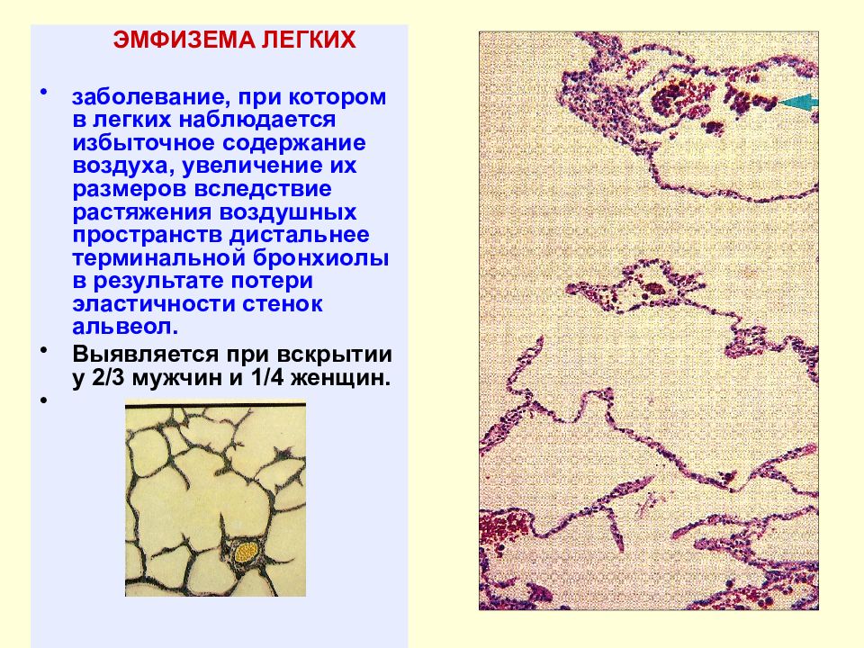 Эмфизема легких это. Хроническая эмфизема гистология. Уровень поражения эмфизема легких. Эмфизема легких препарат.