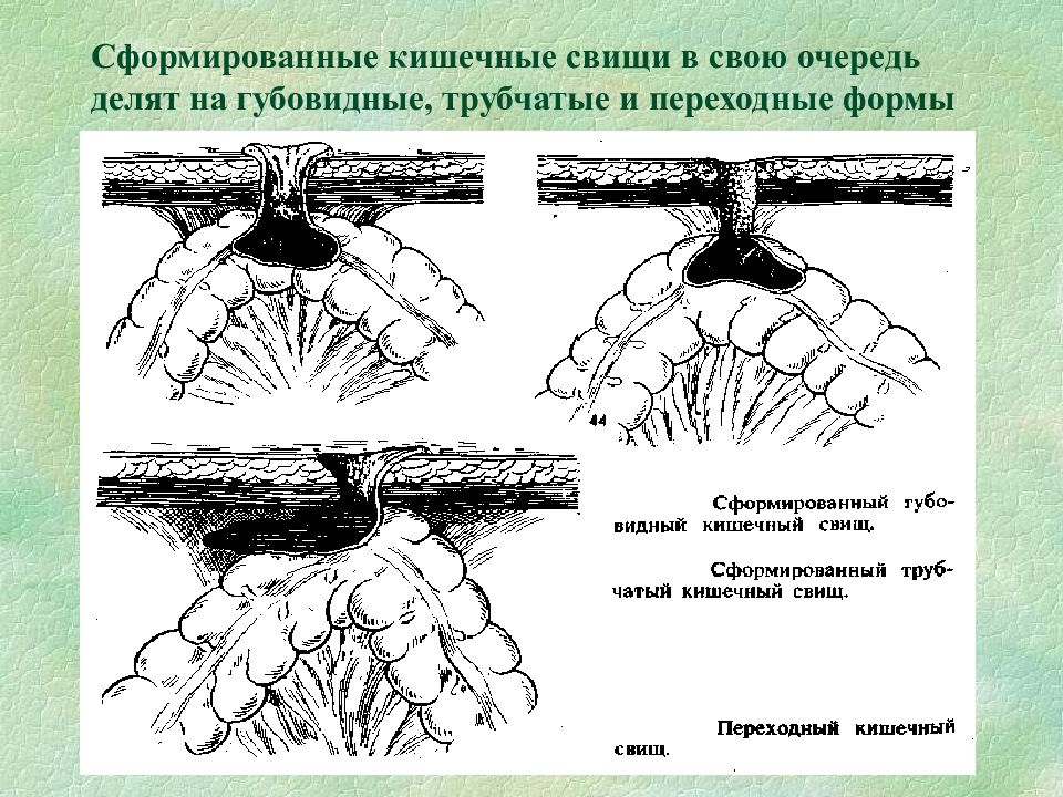 Лечение кишечных свищей