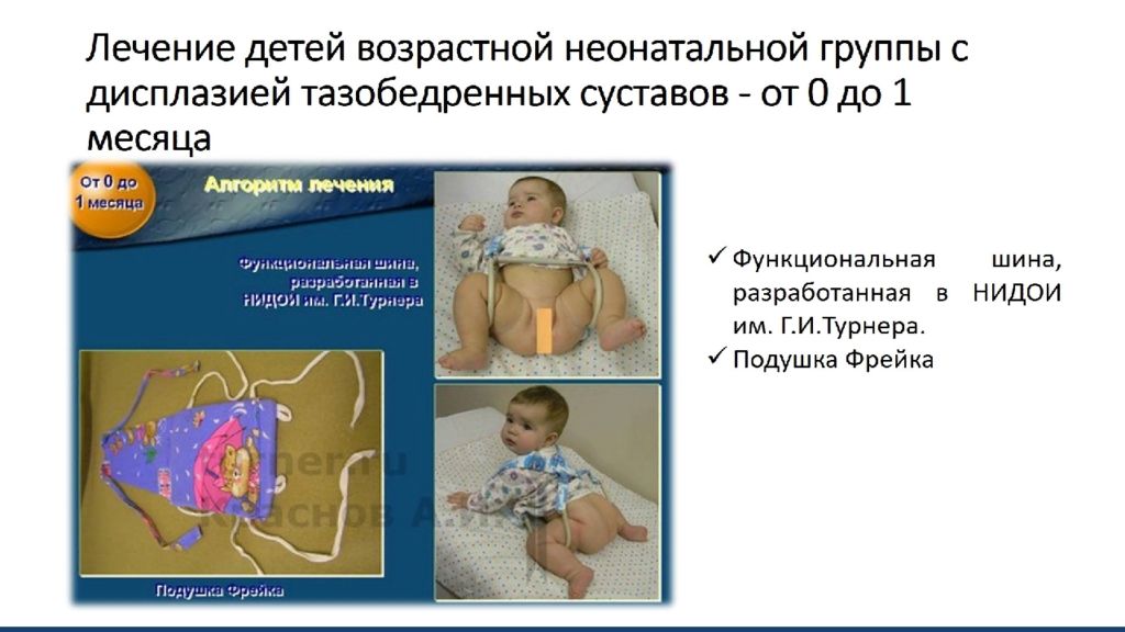 Дисплазия сустава у новорожденного лечение. Гипсование дисплазия тазобедренного. Дисплазия тазобедренных суставов у новорожденных шина. Врожденный вывих тазобедренного сустава. Дисплазия тазобедренных суставов шина.