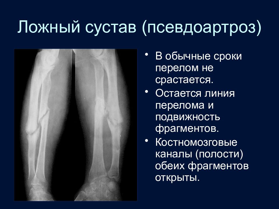 Ложные суставы презентация