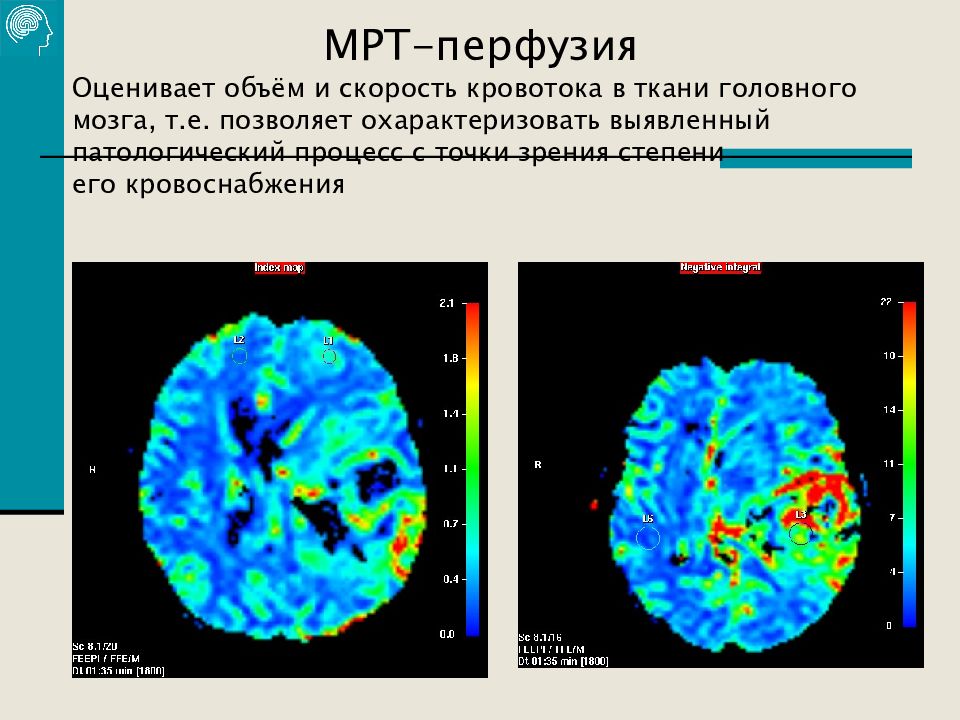 Диффузия и перфузия. Кт перфузия головного мозга методика. Кт перфузия головного мозга при ишемическом. Перфузия кт головного мозга инсульт. Магнитно-резонансная перфузия головного мозга.