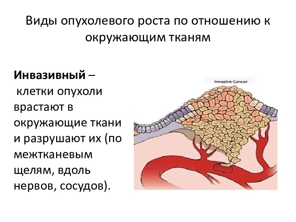 Подпишите картинки виды опухолевого роста