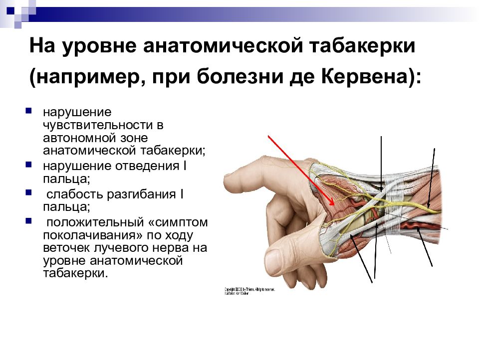 Симптом де кервена. Болезнь де Кервена лучезапястного сустава. Невропатия лучевого нерва. Лучевой локтевой и срединный нервы.