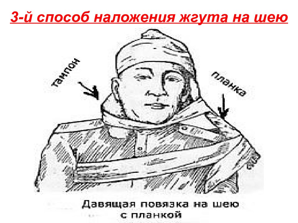 Наложение жгута при ранении шеи. Техника наложения жгута на сонную артерию. Как наложить жгут на ше. Кровоостанавливающий жгут на шею. Надожегие жгута натшею.