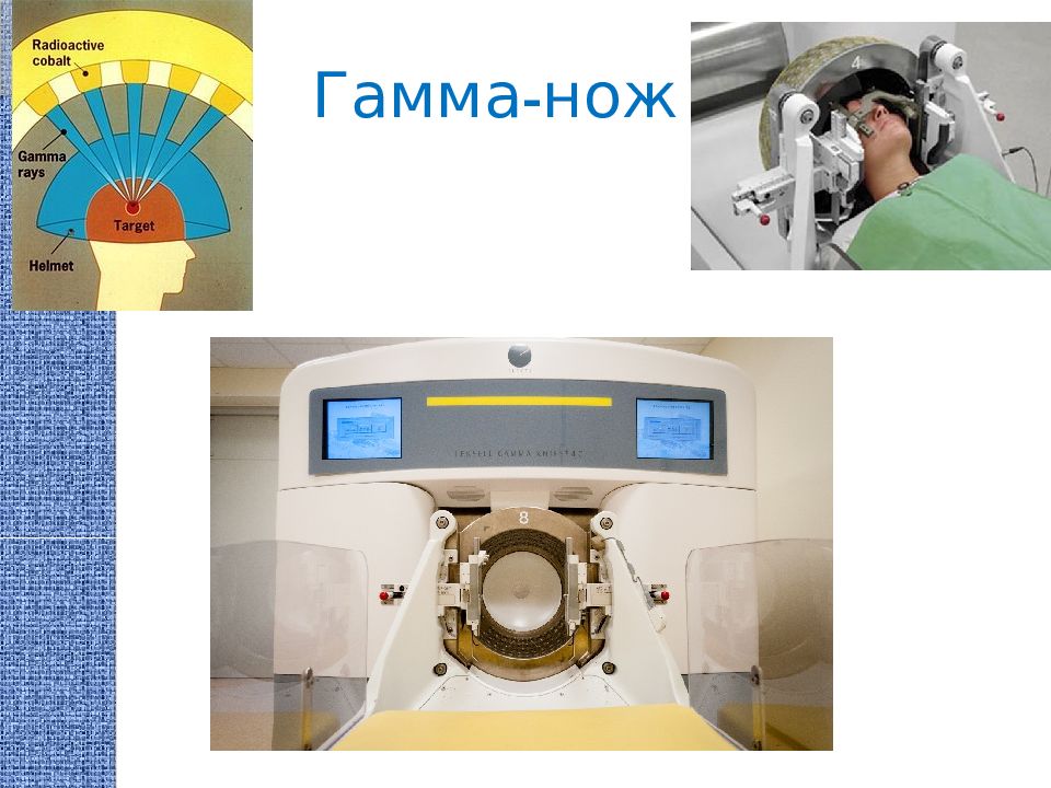 Стереотаксическое облучение. Лучевая терапия гамма нож. Стереотаксическая лучевая терапия. Гамма нож показания.