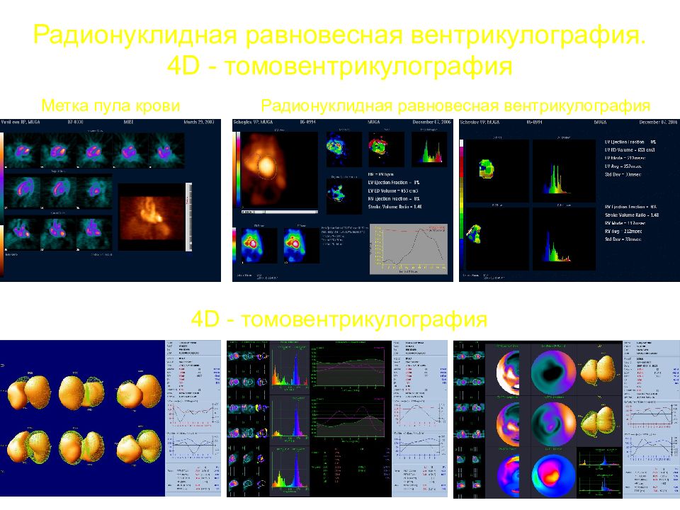 Радионуклидная диагностика. Радионуклидная вентрикулография. Равновесная вентрикулография. Радионуклидное исследование головного мозга. Радионуклидная вентрикулография при ИБС.