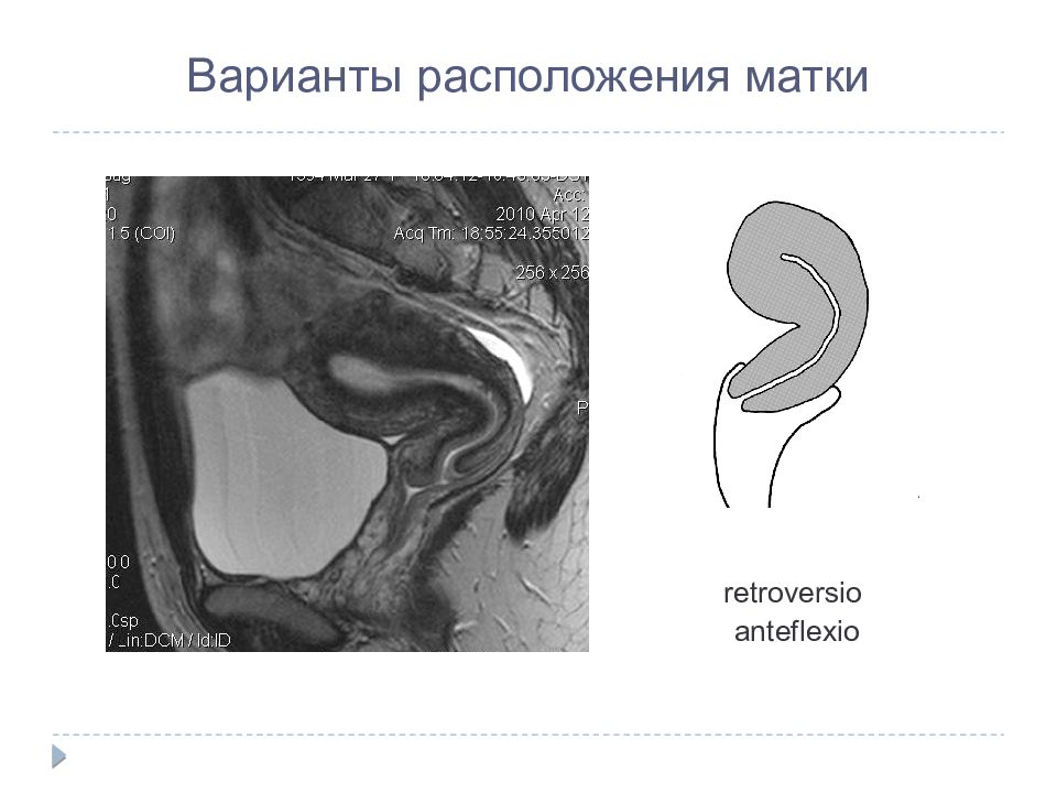 Матка расположена. Антеверзио антефлексио. Антеверзио и антефлексио матки. Anteversio Flexio матки. Перегиб матки anteflexio.