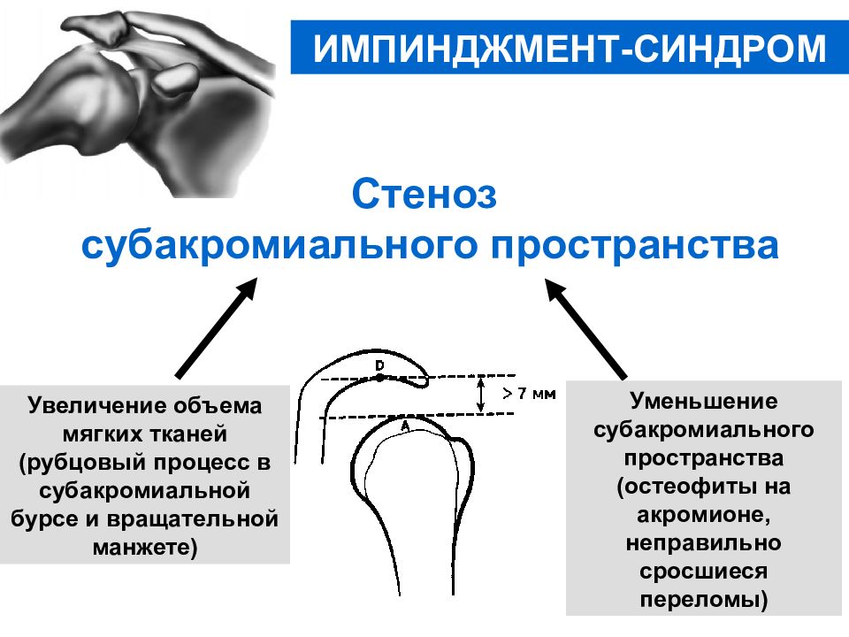 Импиджмент левого плечевого сустава. Импиджмент синдром плечевого сустава. Импинджмент-синдром плечевого сустава рентген. Импиджмент плечевого сустава рентген. Подакромиальный импинджмент синдром плечевого сустава.