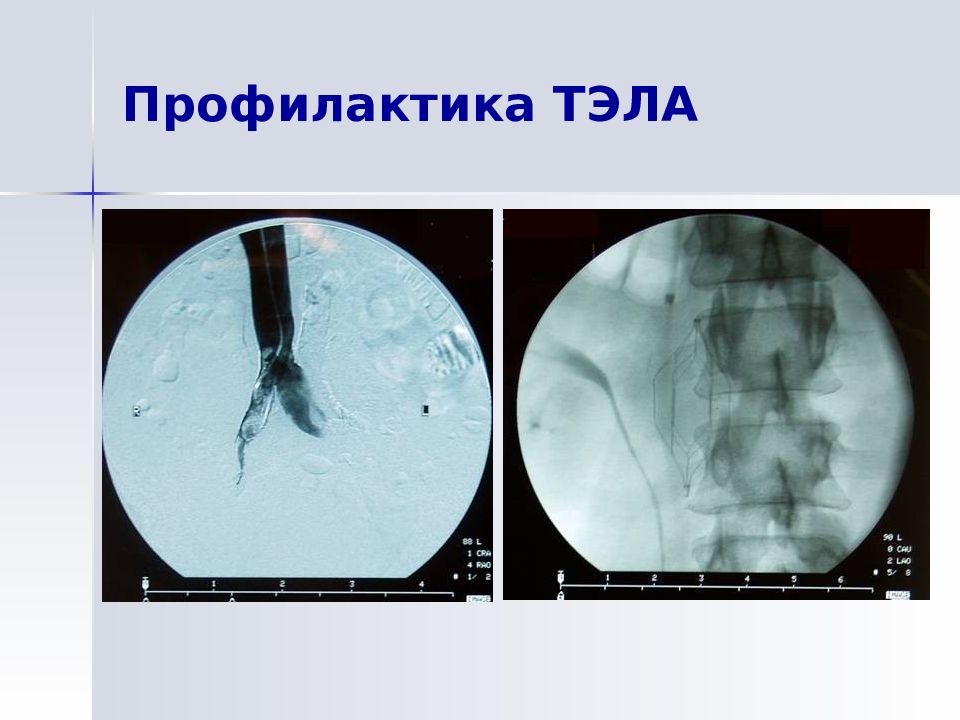 Заболевание тромбоэмболия легочной артерии. Профилактика Тэла. Профилактика тромбоэмболии. Профилактика Тэла профилактика. Профилактика легочной тромбоэмболии.