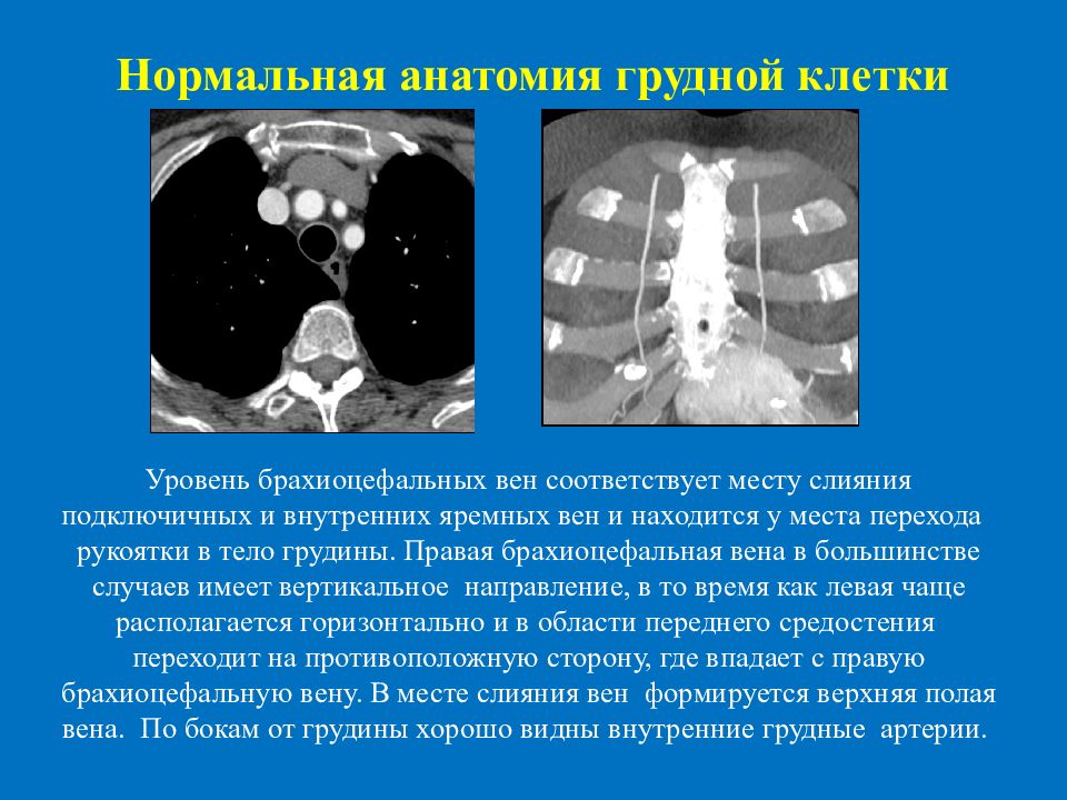 Кт грудной клетки. Кт грудной клетки сбоку. Анатомия грудины на кт. Кт анатомия грудной клетки. Нормальное кт грудной клетки.