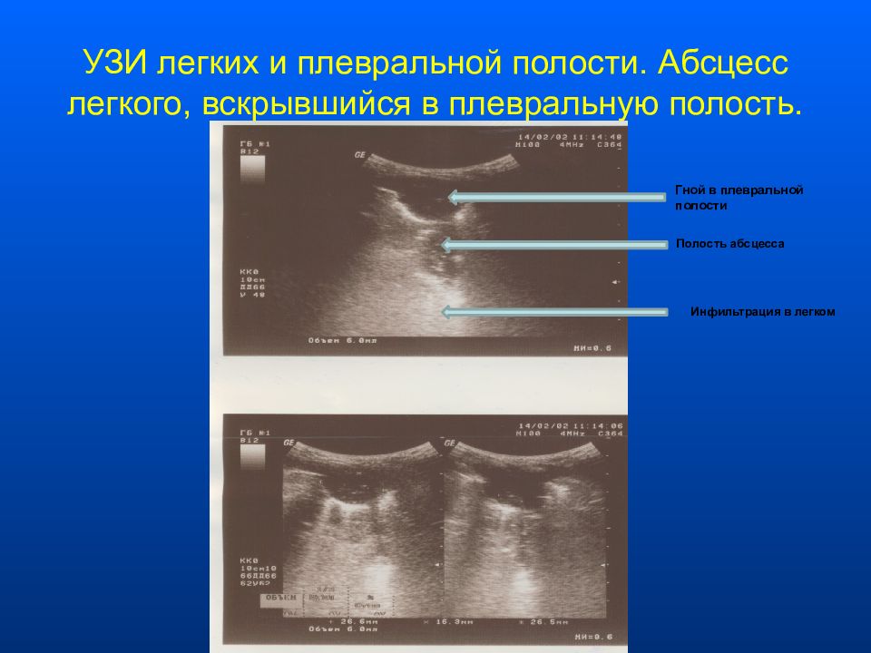 Узи плевральной полости протокол образец