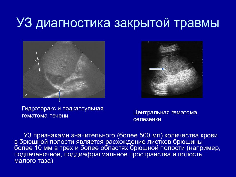 Закрытая травма живота картинки