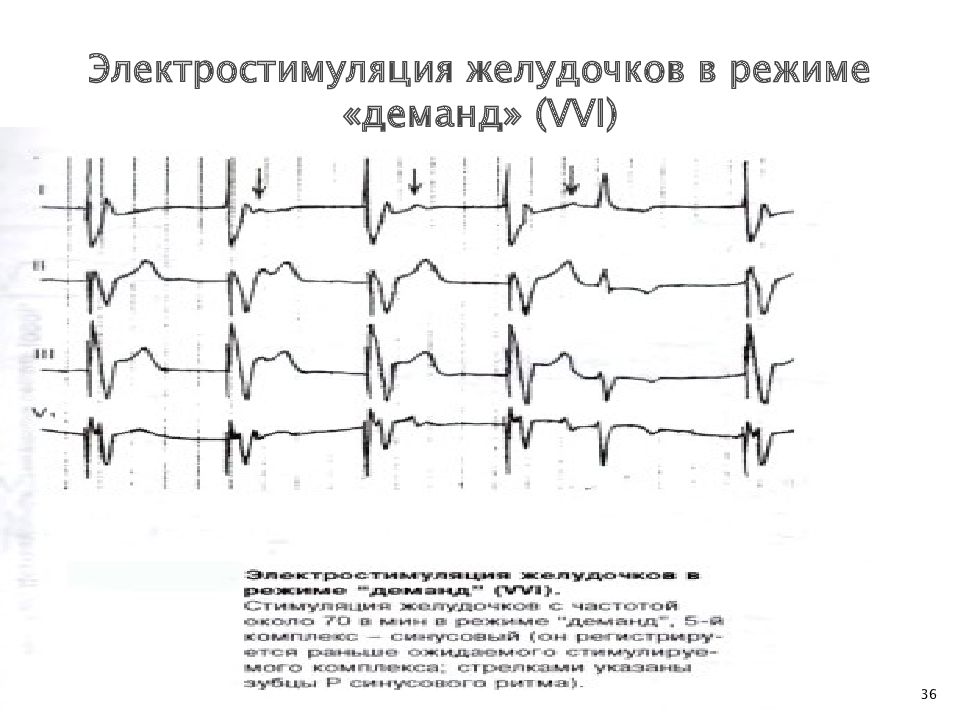 Режимы работы экс. Экс в режиме VVI. Режим экс demand. Электростимуляция на ЭКГ. ЭКГ при двухкамерной стимуляции.