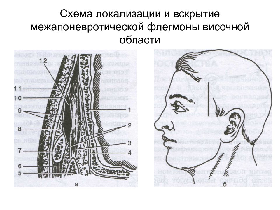 Височная область. Слои височной области топографическая анатомия. Срединные флегмоны в височной области. Глубокая флегмона височной области. Височная область топографическая анатомия.