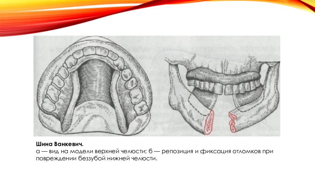 Шина Ванкевича — двощелепна.