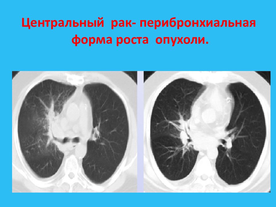 Центральный рак кт. Перибронхиальная опухоль. Эндобронхиальный рост опухоли. Перибронхиально Узловая форма. Перибронхиальный рост опухоли.