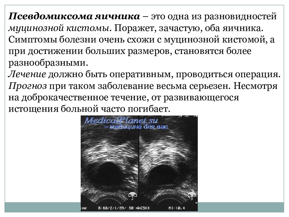 Удаление яичников инвалидность. Параовариальные кисты яичников. Эндометриозная киста яичника злокачественная УЗИ. Доброкачественные новообразования яичников. Доброкачественное новообразование яичника.