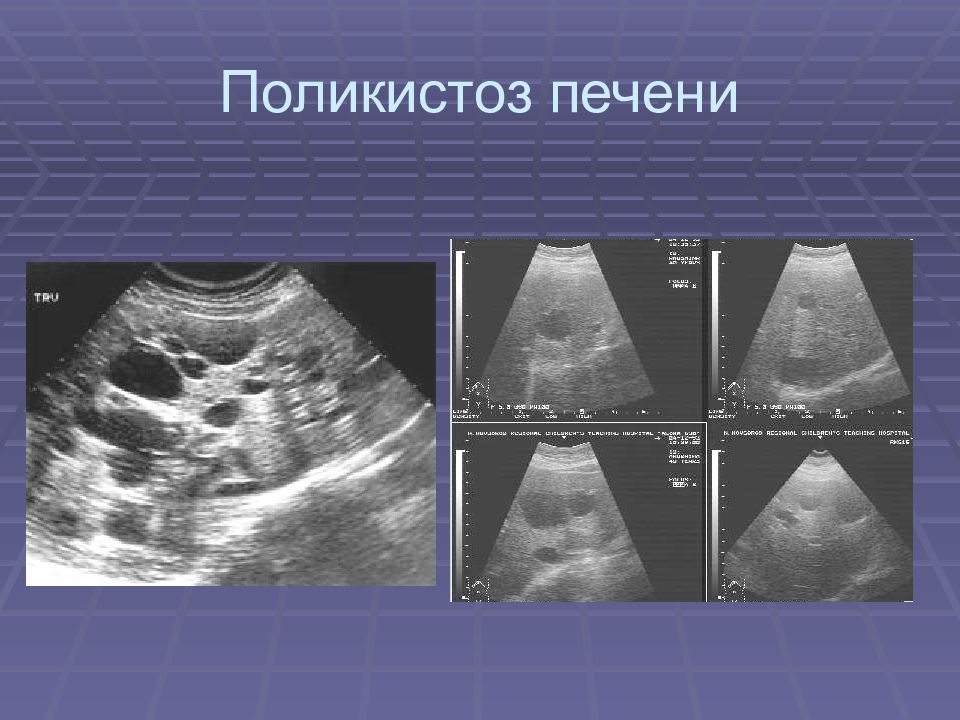 Поликистоз почек на узи. Эхограмма поликистоза почек.