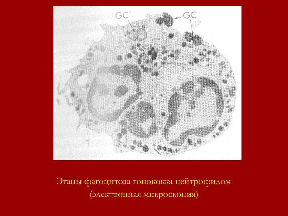 Незавершенный фагоцитоз гонококков в организме человека рисунок