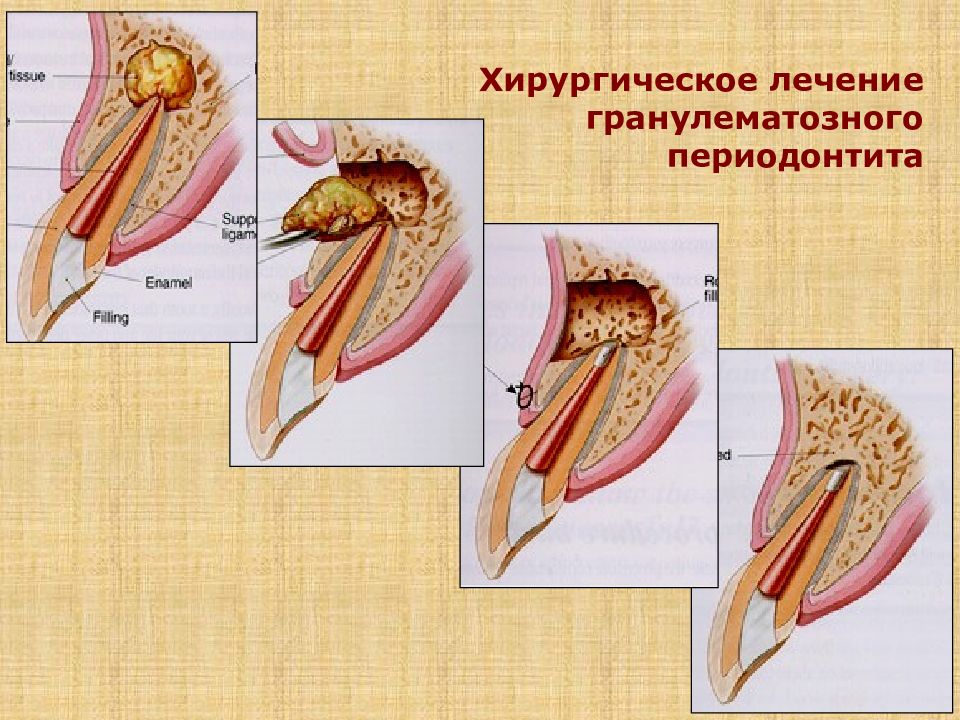 Хирургическое лечение периодонтитов презентация