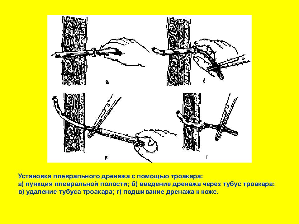 Дренирование плевральной полости. Троакарное дренирование плевральной полости. Протокол дренирования плевральной полости. Дренирование плевральной полости техника. Установка плеврального дренажа.