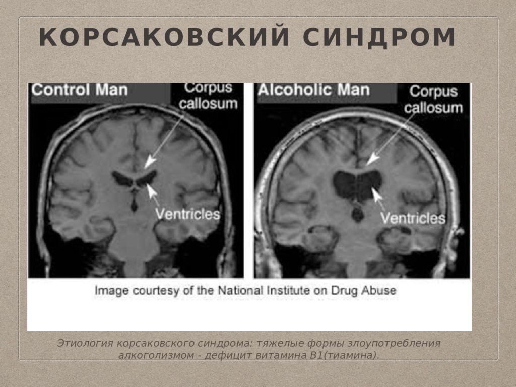 Синдром головного мозга. Корсаковский синдром этиология. Корсаковский амнестический синдром этиология. Болезнь Корсакова. Болезнь Вернике-Корсакова.