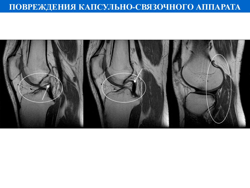 Дисторсия капсульно связочного аппарата. Повреждение капсульно-связочного аппарата. Повреждение повреждение капсульно-связочного аппарата.. Закрытая травма капсульно связочного аппарата. Травмирование капсульно-связочного аппарата суставов.