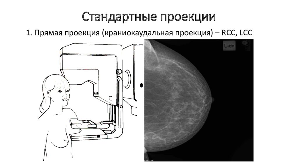 Матричный рисунок высокой плотности тип 3 молочной железы