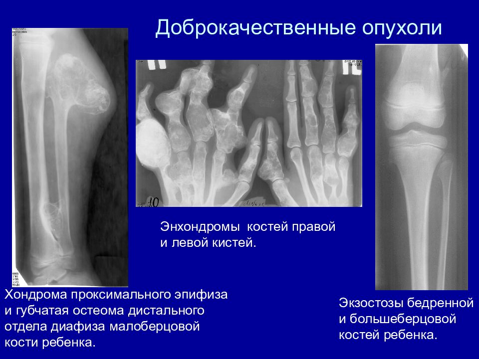 Опухоли костей презентация