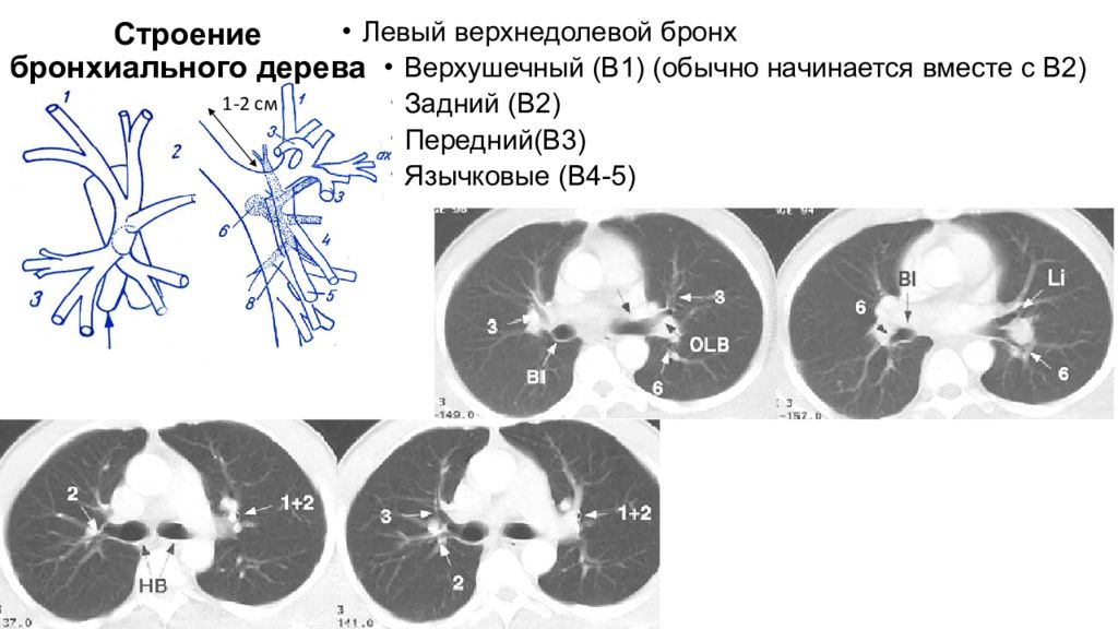 Укажите структуры бронхиального дерева уже не имеющие в своих стенках хряща