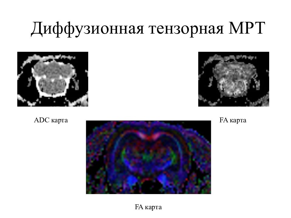 Мрт диффузное тензорное изображение