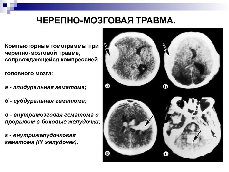 Травмы черепа и головного мозга. Сеоепно мозгоапя Травиа. Черепно-мозговая травма. Черпная Мозгово травма. Открытая черепно-мозговая травма.