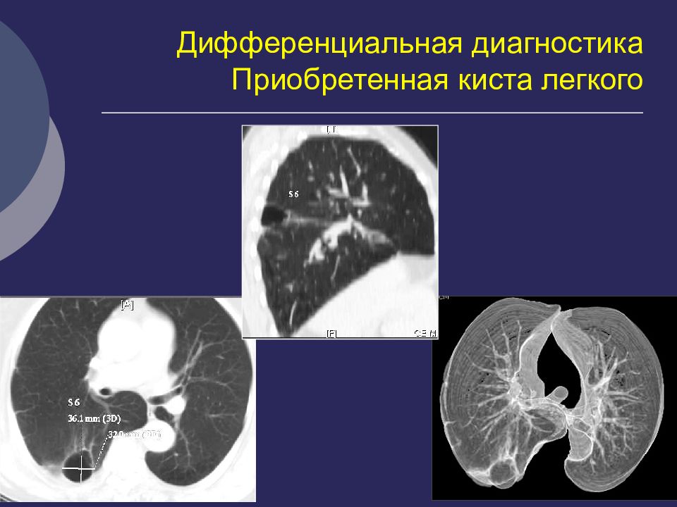 Кисты легких у детей презентация